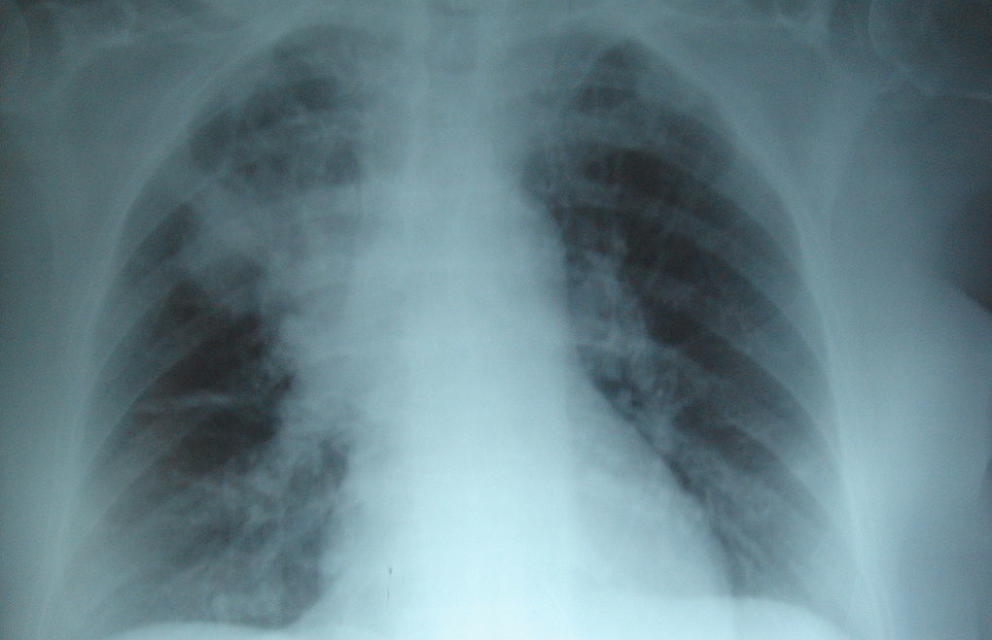 Radiografía del pulmón