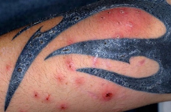 sintomas-de-tatuajes-infectados-taringa
