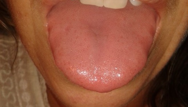 lengua-inflamada