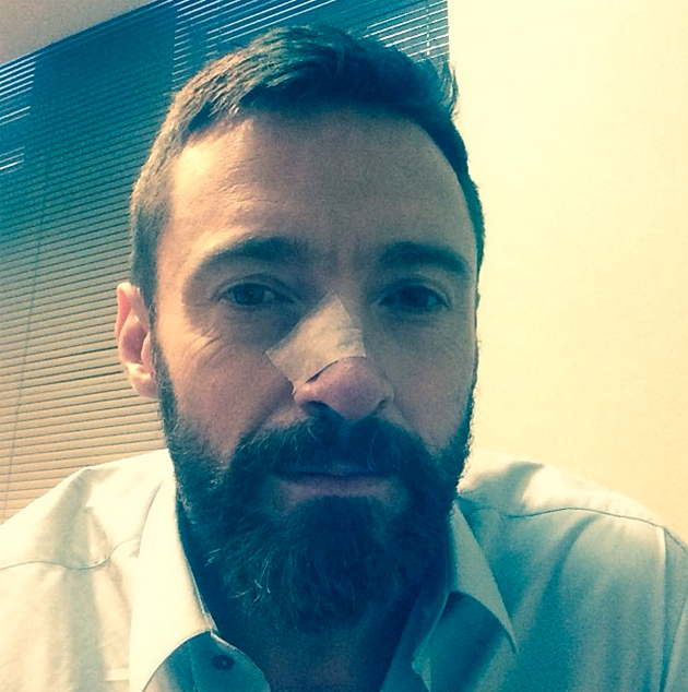 Hugh Jackman - Operado de Nariz