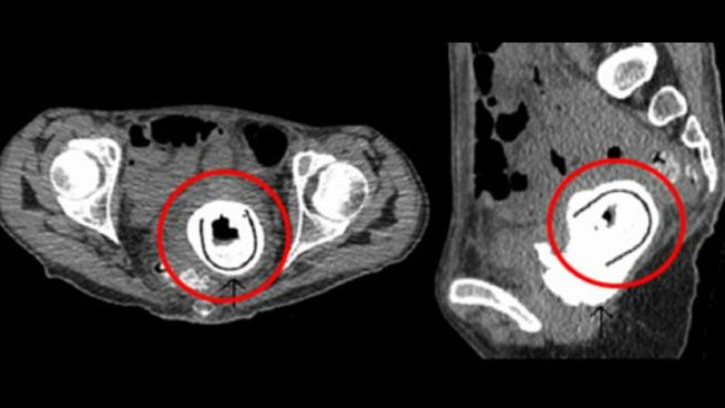 Radiografía de vagina-utero